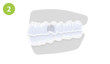 出っ歯の場合画像2