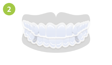 ガタガタした歯並びや八重歯の場合画像2