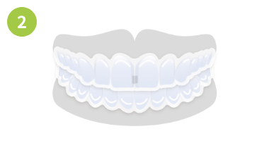 すきっ歯の場合画像2